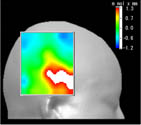 fNIRS 突発的血流変化＿図形推測（透視条件）における右側頭葉　簡易マップ表示
